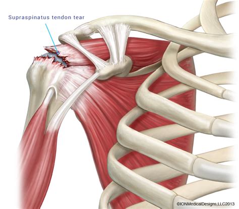 rotator cuff tear physical identification